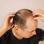 Hair Loss Treatment in Riyadh 23
