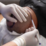Is FUSS Hair Transplant in Dubai Suitable for Diffuse Loss