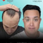 Sapphire Fue Hair Transplant Costs in Turkey: and What You Should Really Know 3 Sapphire Fue Hair Transplant Costs in Turkey: and What You Should Really Know