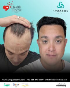 Sapphire Fue Hair Transplant Costs in Turkey: and What You Should Really Know 1 Sapphire Fue Hair Transplant Costs in Turkey: and What You Should Really Know