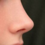 nose tip plasty in islamabad 2