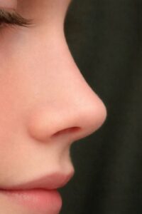 Nose Tip Plasty: From Consultation to Recovery