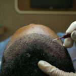 Scarless Hair Transplant in Dubai 7