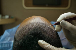 Is Scarless Hair Transplant in Dubai Suitable for Younger Men