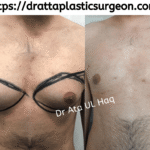 Gynecomastia surgeon in Lahore