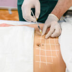Fat Melting Injections: How to Choose a Qualified Provider 3 Fat Melting Injections: How to Choose a Qualified Provider