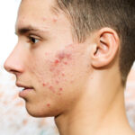 Pimples Treatment in Dubai for Acne With Post-Pimple Dark Marks 3 Pimples Treatment in Dubai for Acne With Post-Pimple Dark Marks