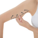 Arm Lift Surgery for Improving Contour Concerns That Exercise Cannot Fix