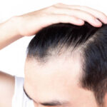What to Expect From PRP Hair Treatment in Riyadh 3 What to Expect From PRP Hair Treatment in Riyadh