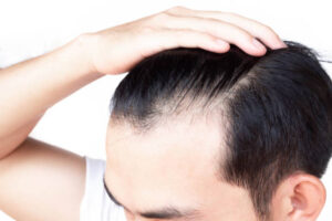 What to Expect From PRP Hair Treatment in Riyadh 1 What to Expect From PRP Hair Treatment in Riyadh