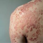 How Can Skin Diseases Treatment Reduce Skin Concerns?
