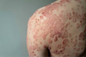 How Can Skin Diseases Treatment Reduce Skin Concerns? 1 How Can Skin Diseases Treatment Reduce Skin Concerns?