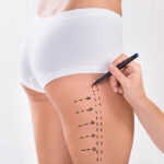 Body Contouring Procedure in Riyadh for a More Defined Shape 3 Body Contouring Procedure in Riyadh for a More Defined Shape