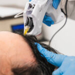 Hair Transplant in Al Ain for Hair Loss After Major Weight Loss 3 Hair Transplant in Al Ain for Hair Loss After Major Weight Loss