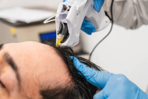 Hair Transplant in Al Ain for Hair Loss After Major Weight Loss 1 Hair Transplant in Al Ain for Hair Loss After Major Weight Loss