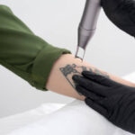 Laser Tattoo Removal in Riyadh for Unwanted Tattoos