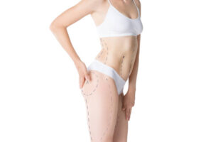 Liposuction in Riyadh: Body Sculpting vs Weight Reduction