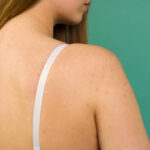How to Reduce Redness and Inflammation From Back Acne 3 How to Reduce Redness and Inflammation From Back Acne