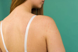 How to Reduce Redness and Inflammation From Back Acne 1 How to Reduce Redness and Inflammation From Back Acne
