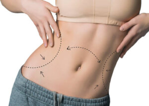 Liposuction in Riyadh: Myths and Facts You Should Know 1 Liposuction in Riyadh: Myths and Facts You Should Know