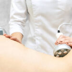 Exploring Venus Legacy for Facial Contouring and Skin Tightening 3 Exploring Venus Legacy for Facial Contouring and Skin Tightening