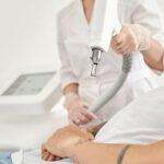 Laser Tattoo Removal in Riyadh for Black Ink Tattoosd 3 Laser Tattoo Removal in Riyadh for Black Ink Tattoosd
