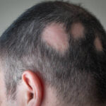 Alopecia Areata Treatment Cost in Riyadh 3