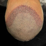FUT Hair Transplant in Dubai Donor Scar Healing