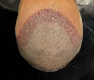 FUT Hair Transplant in Dubai Donor Scar Healing
