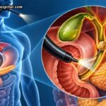 Choosing The Right Hospital For ERCP