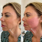 Best Aesthetic Clinics in dubai for Endolift Facial Rejuvenation 3 Best Aesthetic Clinics in dubai for Endolift Facial Rejuvenation