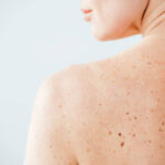 Mole Removal and Professional Skin Evaluation Explained 3 Mole Removal and Professional Skin Evaluation Explained