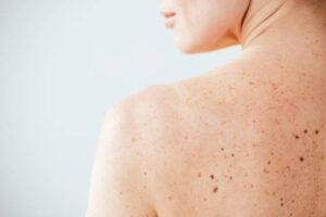 Mole Removal and Professional Skin Evaluation Explained 1 Mole Removal and Professional Skin Evaluation Explained