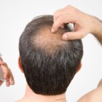 Hair Fall in Women and Men: Simple Guide to Treatment Options in Delhi