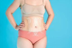 Tummy Tuck Surgery and the Importance of Maintaining Stable Weight 1 Tummy Tuck Surgery and the Importance of Maintaining Stable Weight