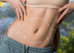 Liposuction Benefits, Procedure Details, and Recovery Expectations 1 Liposuction Benefits, Procedure Details, and Recovery Expectations