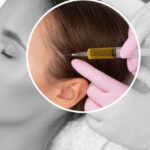 ACell PRP Treatment for Hair in Dubai and Hair Medications