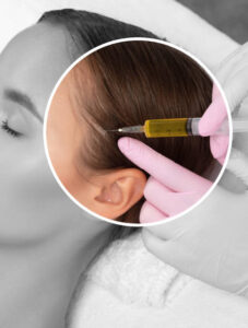 ACell PRP Treatment for Hair in Dubai and Hair Medications 1 ACell PRP Treatment for Hair in Dubai and Hair Medications