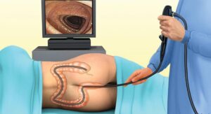 Best Colonoscopy Hospital in Guwahati for Colon Examination