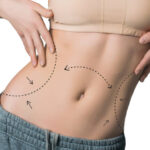 How Liposuction in Riyadh Helps Define Body Contours