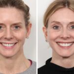 Best Plastic Surgeons in Dubai for Personalized Thread Lift Treatment