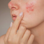 Laser Acne Scar Treatments in Riyadh 25