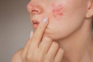 Comparing Laser Acne Scar Treatments for Different Skin Concerns 1 Comparing Laser Acne Scar Treatments for Different Skin Concerns