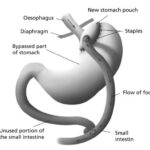 gastricbypass