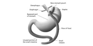 How to Sleep Comfortably After Bariatric Surgery