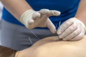 Dry Needling vs Acupuncture: Which Approach May Be Right for Your Pain? 1 Dry Needling vs Acupuncture: Which Approach May Be Right for Your Pain?