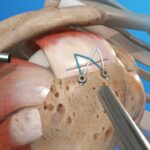 Shoulder Surgeon in Troy MI | Expert Treatment for Shoulder Injuries