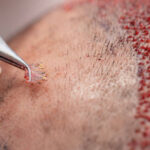 DHI Direct Hair Implant in Dubai 3