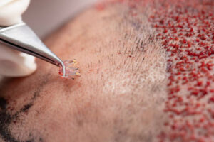 DHI Direct Hair Implant in Dubai for Mid Scalp Density