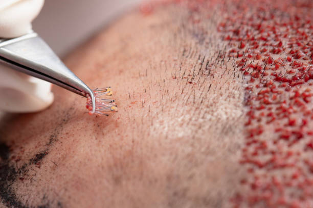 DHI Direct Hair Implant in Dubai 3